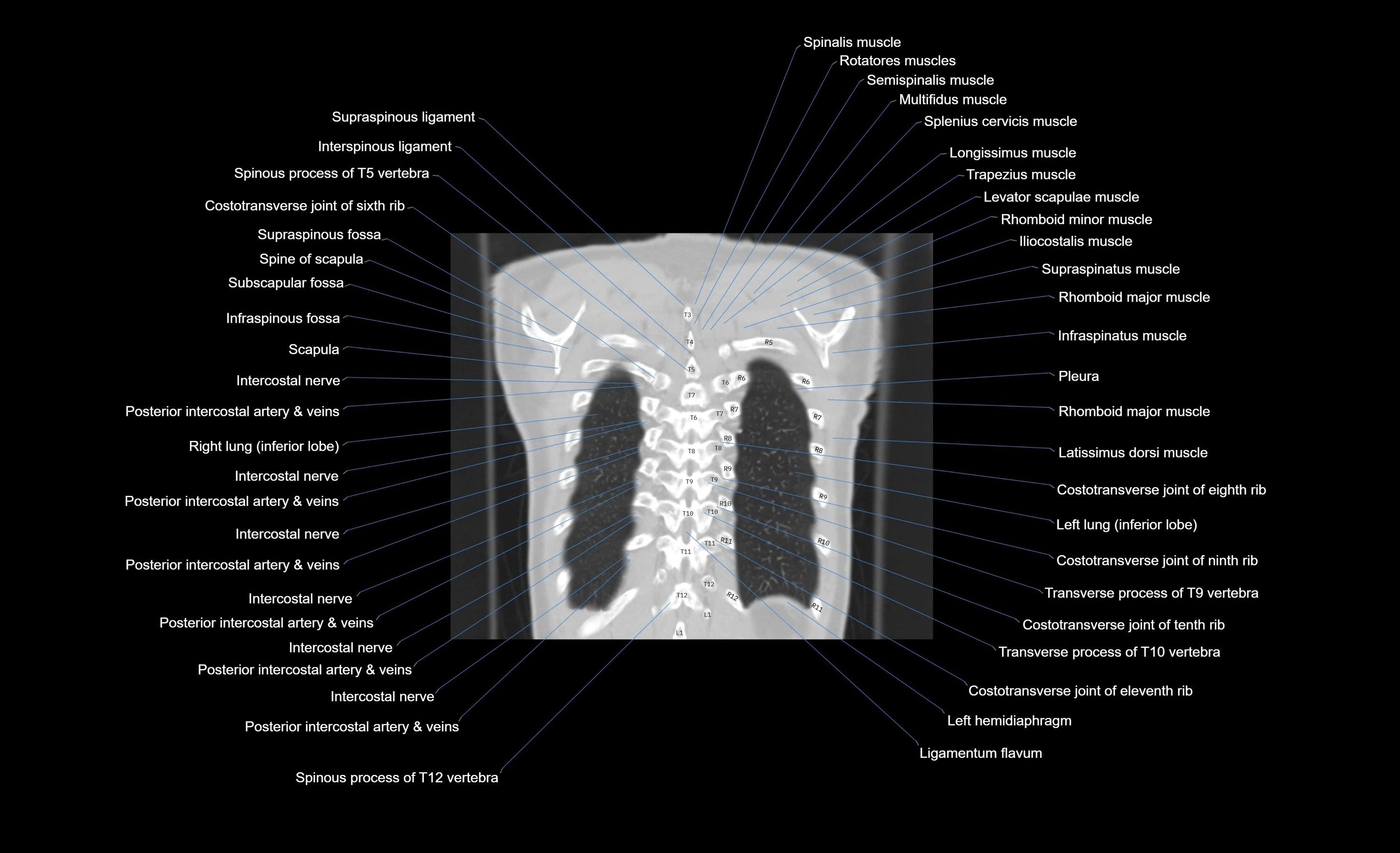 CT chest (thorax) lung window window labelled coronal cross sectional anatomy radiology image-00020.webp